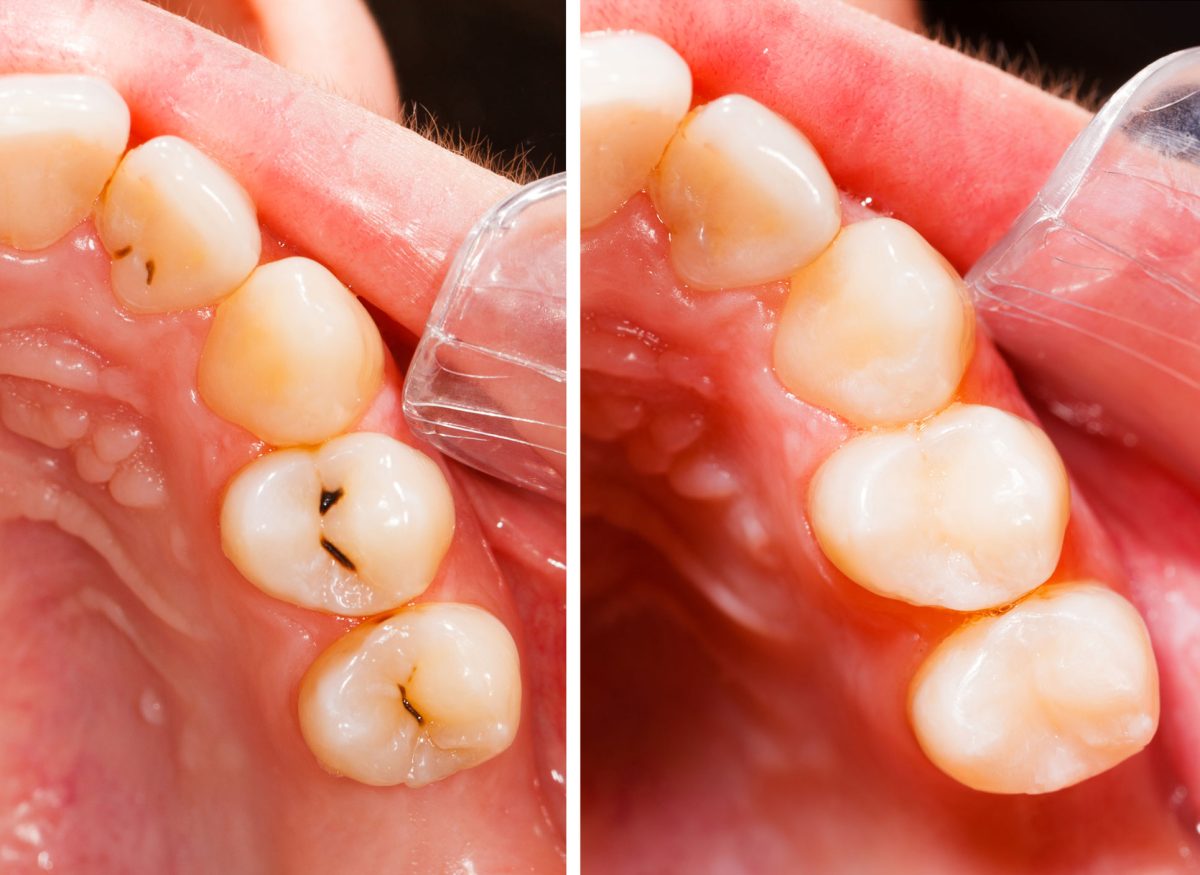 Vor und nach der Zahnfüllung
