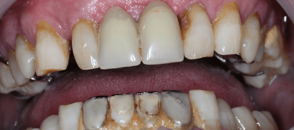 Komplette orale Rehabilitation nach 15 Jahren bei Artdent Zahnklinik (bevor)