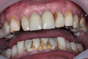 Komplette orale Rehabilitation nach 15 Jahren bei Artdent Zahnklinik (bevor)