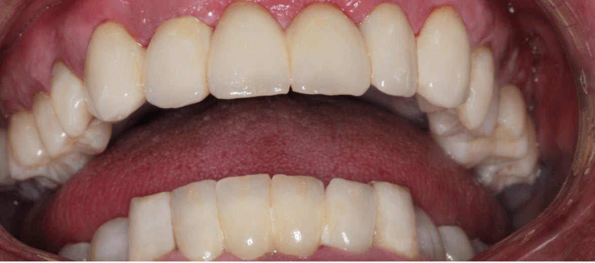 Komplette orale Rehabilitation nach 15 Jahren bei Artdent Zahnklinik