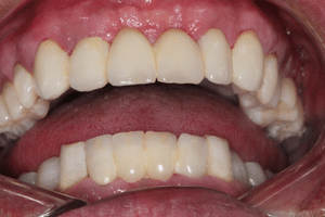 Komplette orale Rehabilitation nach 15 Jahren bei Artdent Zahnklinik